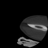 SPORK, NICO - 22.03.1976 - 02.08.2022 - CT obere Extremität - 17:51:17